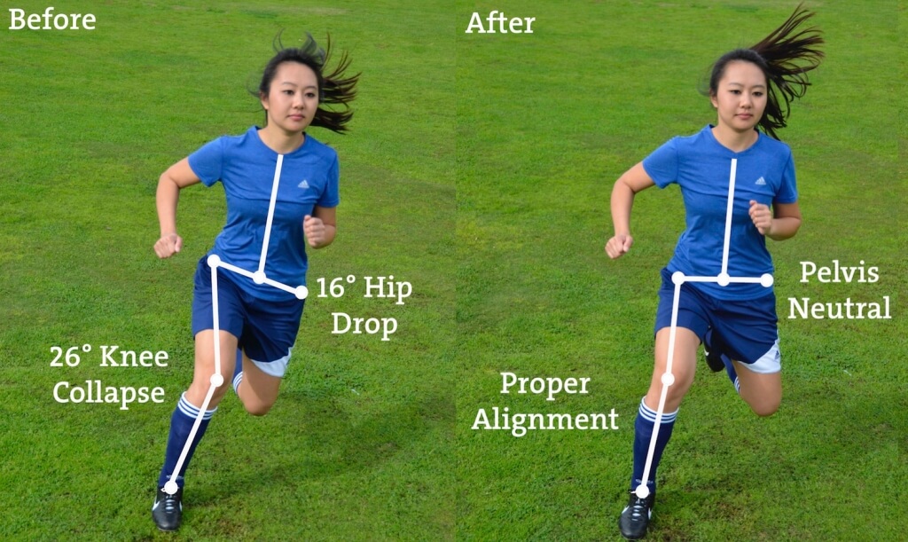 before2 1024x611 1 ACL Tears in Youth Athletes: Are female athletes at a higher risk for tears?